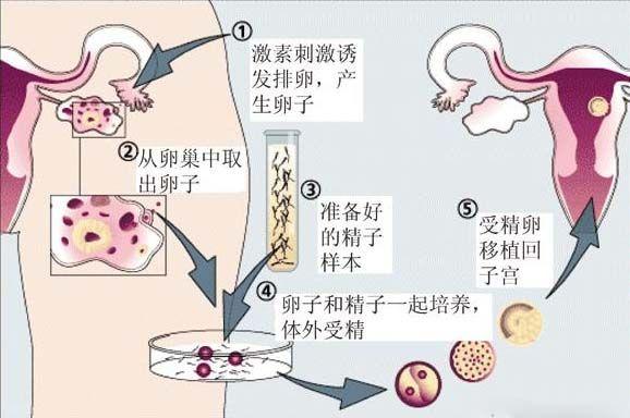 国内借卵试管代怀流程(国内借卵试管代怀流程详解)